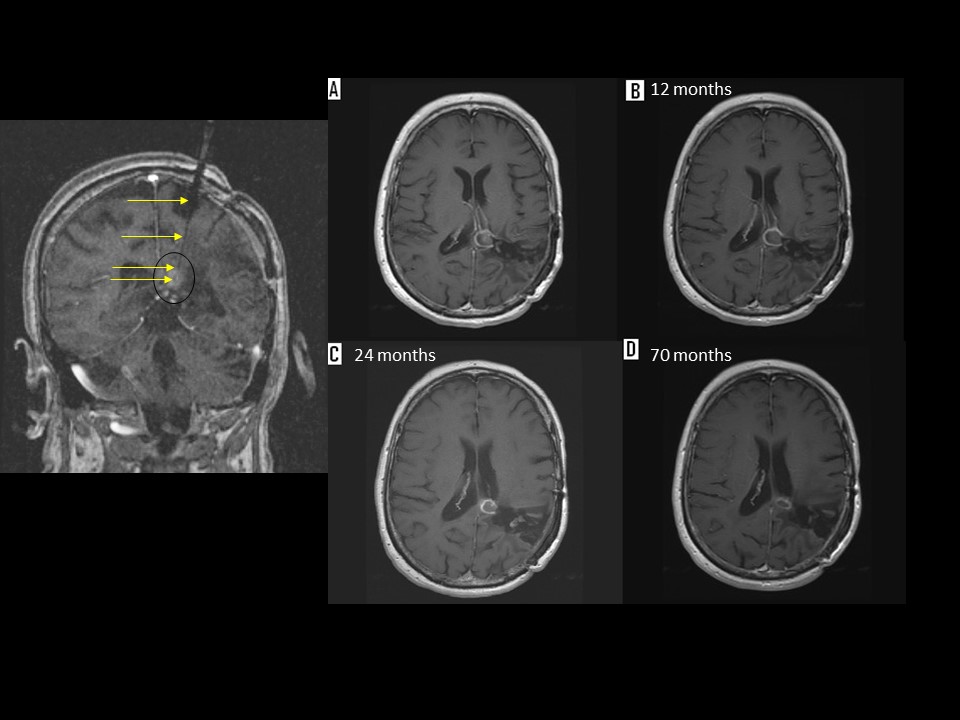 Figure: This is a patient with a recurrent anaplastic ependymoma located below the splenium of the corpus callosum. The patient had undergone multiple craniotomies, fractionated radiation as well as radiosurgery. She underwent placement of a transparietal laser catheter using the Visualase System (Left image). The images on the right represent the follow up images after MRI guided laser therapy. 